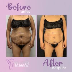 Belleza Colombiana - Before and after #DFWBodyContouring #BodyContouringSpecialist #DallasColombianSpa #DFWBodyContouring #DFWBodyContouringSpa #DFWSpa