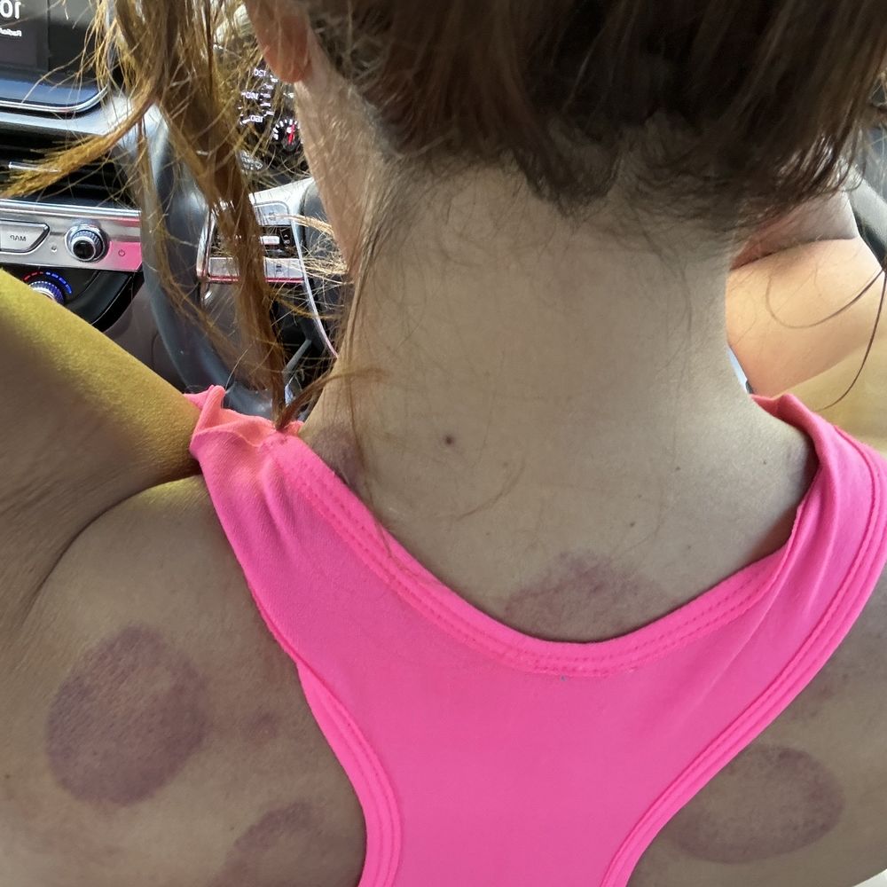 The Serenity Center - After my deep tissue massage with cupping. - Massage Therapy Near Me - Las Vegas, Nevada