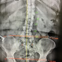 Progressive Chiropractic - Scoliosis can lead to many problems if left untreated!