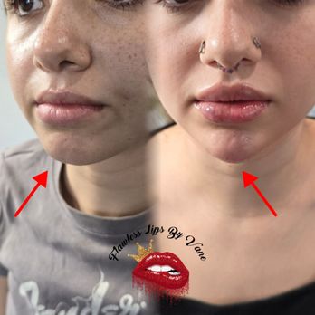 Flawless Lips - Chin filler - Teeth Whitening Near Me Flawless Lips - Chin filler - Teeth Whitening Near Me