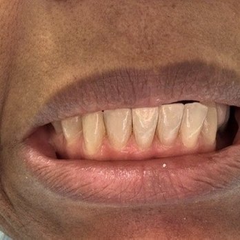 Downey Modern Dentistry - After - General Dentistry Near Me - Downey, California