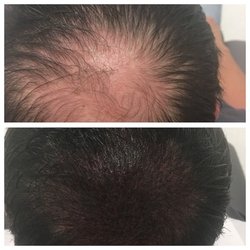 Crown Clinic - Scalp Micropigmentation