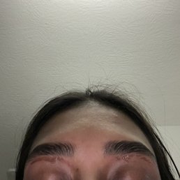 chemical burns from wax after brow lamination chemical burns from wax after brow lamination