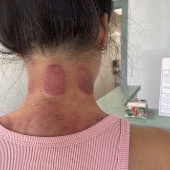 Central Earth  - Cupping and guasha - Naturopathic/Holistic Near Me - Aiea, Hawaii