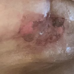 Edward Eades, MD - Eades Plastic Surgery - Same site but you can see the damage it has created.