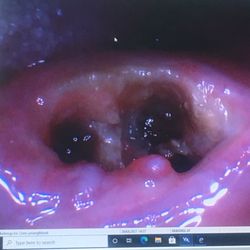 San Ysidro Dental Care Barr Yadira - Here is a picture of my mouth after they mangled my gums and left broken pieces of Teeth in my mouth with exposed bone Thanks