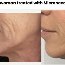 North Shore Acupuncture - 55 yo woman, after two sessions of Miconeedling.Micro needling advantage treats face, neck, hands and chest. All, age identifier signatures.