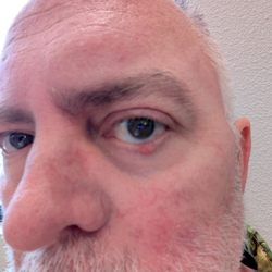 Medical Center Ophthalmology Associates - Eyelid surgery