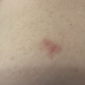 Super 8 by Wyndham Plainview - Bedbug bites - Hotels Near Me - Plainview, Texas