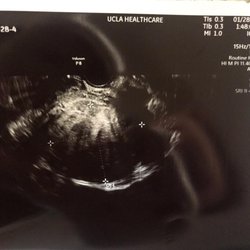 Revana Lukman, MD - Ultrasound of my almost 10cm fibroid tumor
