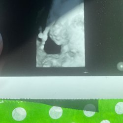 Miracle In Progress 3D4D Ultrasound Studio - LV - Baby's face!