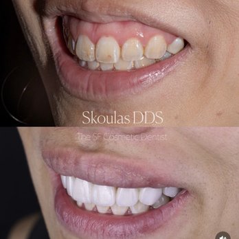 Skoulas DDS - The SF Cosmetic Dentist - Before and after - Cosmetic Dentists Near Me - San Francisco, California Skoulas DDS - The SF Cosmetic Dentist - Before and after - Cosmetic Dentists Near Me - San Francisco, California