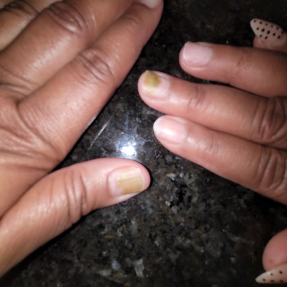 Received a Nasty Green infection from V-Star Nails in Snellville Received a Nasty Green infection from V-Star Nails in Snellville
