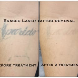 Erased Laser Tattoo Removal - After the 2nd treatment. Erased Tattoo Removal Las Vegas www.erasedlasertattooremoval.com