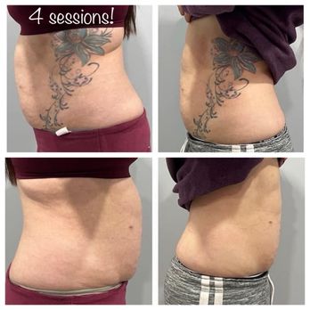 Pure Esthetics - Body contouring! - Estheticians Near Me - Phoenix, Arizona Pure Esthetics - Body contouring! - Estheticians Near Me - Phoenix, Arizona