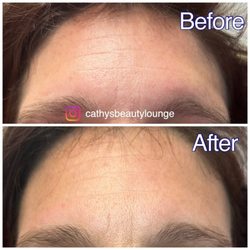 Cathy's Beauty Lounge - Watch forehead lines vanishing in a single Microchanneling session--a forehead transformed, proof that magic exists in skincare!