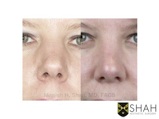 Shah Aesthetic Surgery - Rhinoplasty and Facelift Specialist by null