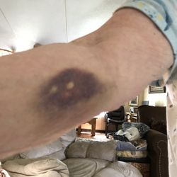HealthCARE Express - Bruise