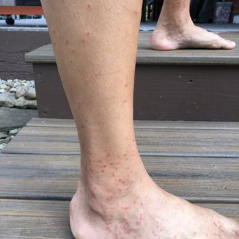 Silver Canoe Campground - bed bug bites - Campgrounds Near Me - Rural Valley, Pennsylvania Silver Canoe Campground - bed bug bites - Campgrounds Near Me - Rural Valley, Pennsylvania