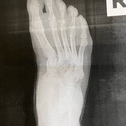 R foot metatarsal adductus, 8.+ mm plantar fascia R foot metatarsal adductus, 8.+ mm plantar fascia