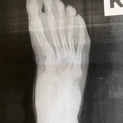 Frederick Foot and Ankle: MD - WV - R foot metatarsal adductus, 8.+ mm plantar fascia