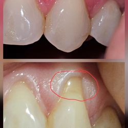 Periodontal & Implant Treatment Center - Reza Malekzadeh, DDS - Before n after gum graft