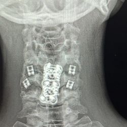 Texas Back Institute - Spinal cage & disc replacements C4, C5, C6