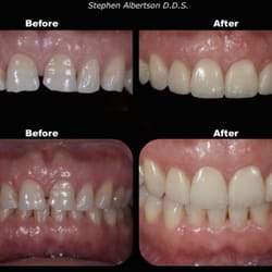 Stephen Albertson, DDS - A veneer Case completed by Dr. Albertson. 10 teeth were restored using porcelain veneers to achieve a more youthful and esthetic smile.