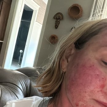 LaserAway - This is 24 hours later - Medical Spas Near Me - Los Angeles, California LaserAway - This is 24 hours later - Medical Spas Near Me - Los Angeles, California