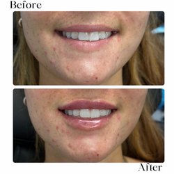 Lip filler before & after