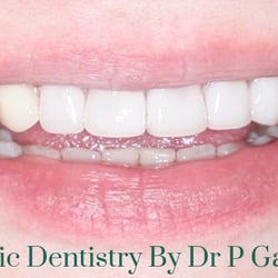 Rock Creek Dental Center - Natural looking crowns on upper teeth, patient of 15 years.