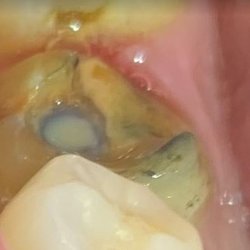 Nathan D Oster, DDS - Here's the tooth missing a crown.