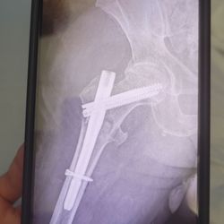 The Bike Smith - My injury