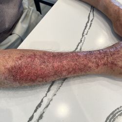 Arsenault Dermatology - 2nd degree burns that this man did not recognize after the treatment this man recommended.