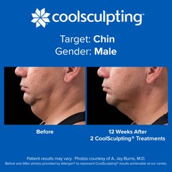 Freeze M.D. CoolSculpting Center - Before and After photos provided by Allergan® to represent results achievable with CoolSculpting.