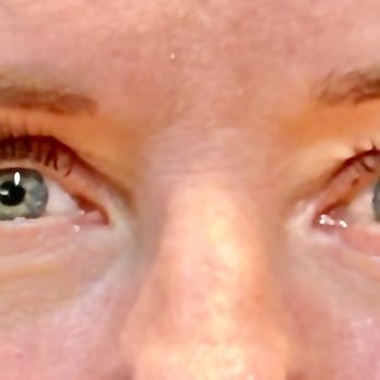 My Life Med Aesthetics - Before Disport - Medical Spas Near Me - Napa, California My Life Med Aesthetics - Before Disport - Medical Spas Near Me - Napa, California