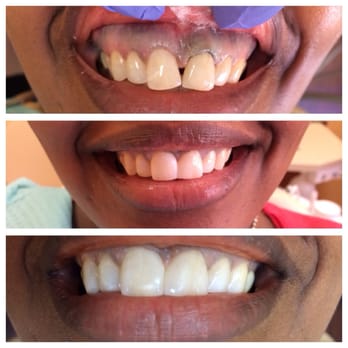 Pearl Smiles Dental - I am posting this picture with pride. - General Dentistry Near Me - Elkridge, Maryland Pearl Smiles Dental - I am posting this picture with pride. - General Dentistry Near Me - Elkridge, Maryland