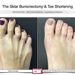 Fixing feet beautifully at Foot First.  For more info about our unique bunion procedure, the Sklar Bunionectomy, visit www.footfirst.com.