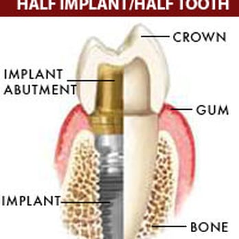 Ralph Kaye, DMD - dental implant - Periodontists Near Me - Philadelphia, Pennsylvania Ralph Kaye, DMD - dental implant - Periodontists Near Me - Philadelphia, Pennsylvania