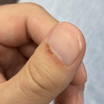 Diana's Nail and Spa - Skin sanded off. She put something on top stop the bleeding but there's basically no skin left by my cuticle. - Nail Salons Near Me - Chicago, Illinois Diana's Nail and Spa - Skin sanded off. She put something on top stop the bleeding but there's basically no skin left by my cuticle. - Nail Salons Near Me - Chicago, Illinois