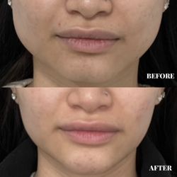Triniti Laser Clinic & Medi Spa - Before & after Masseter Botox