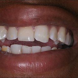 Smiles Art Dentistry - Filling (After restoration)