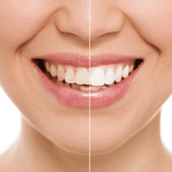 Selma Sunshine Dental - We offer teeth whitening services!