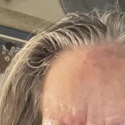 Southeastern Skin Cancer & Dermatology - Shingles!!