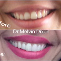 Melvin M Dixon, DDS - Work of Dr Dixon. I am so happy with my smile that I just want to share with the world! lol