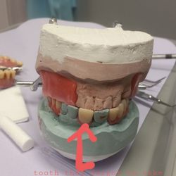 Hampton Family Dentistry - My partials green clay is my real teeth they forgot one....cause they never took out the tooth for impression....duh