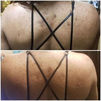 Heavenly Faces - Before & After back facial treatment (s). - Skin Care Near Me - Lodi, California