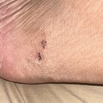 Hawaiian Nail Bar - Chemical burns from my pedicure - Nail Salons Near Me - Irving, Texas Hawaiian Nail Bar - Chemical burns from my pedicure - Nail Salons Near Me - Irving, Texas