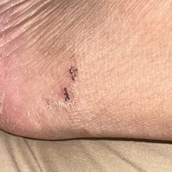 Hawaiian Nail Bar - Chemical burns from my pedicure