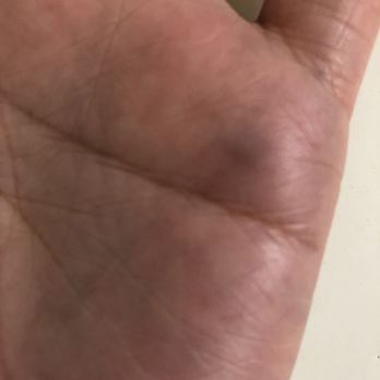 The Glen - Bruise from cracked tile - Karaoke Near Me - Downey, California The Glen - Bruise from cracked tile - Karaoke Near Me - Downey, California